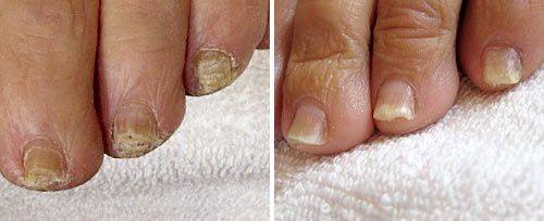 LASER FOR UGLY TOENAILS