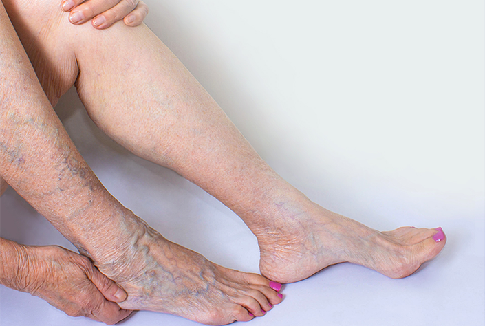 woman touching varicose veins on her lower leg, ankle, and foot