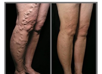 varicose vein treatment Christchurch