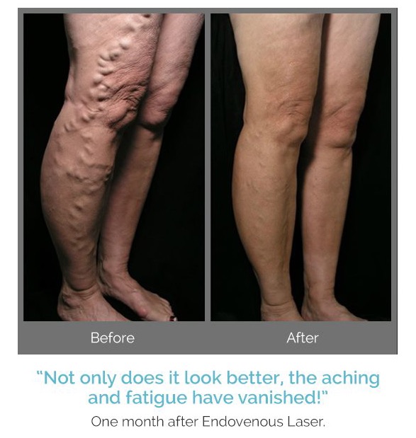 Best Treatment for Varicose Veins, Endovenous laser treatment