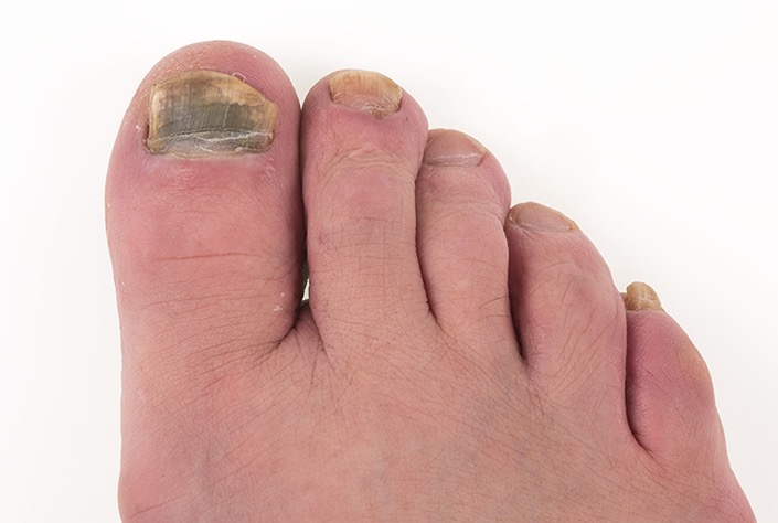 treatment for fungal toes Christchurch