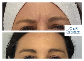 Anti-wrinkle Treatment to Frown