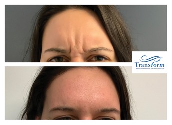 Anti-Wrinkle treatment to Frown Lines