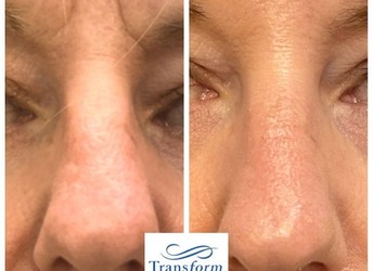 Frown Lines - This lovely client was treated with a combination of botulinum and dermal filler to soften the dynamic and static lines that had formed over time.