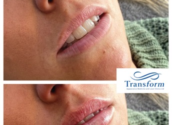 Before and after Lip Enhancement - lip filler.