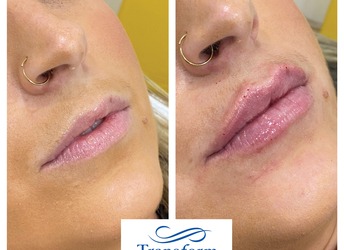 Lip Filler treatment - before and after. Christchurch