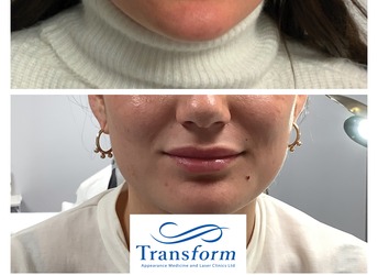 Before and after Lip Enhancement - lip filler.