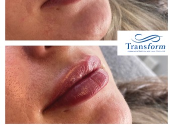 Before and after Lip Enhancement - lip filler.