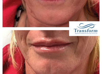 Lip enhancement - before and after.