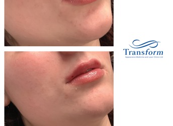 Before and after Lip Enhancement - lip filler.