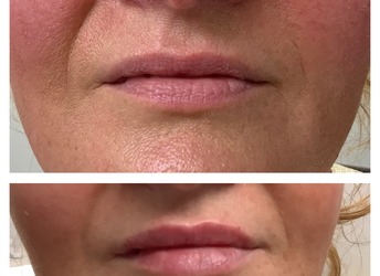 Before and after Lip Enhancement - lip filler.