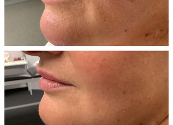 Before and after Lip Enhancement - lip filler.