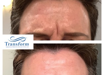 Before and after treatment to frown line using a combination of anti-wrinkle and dermal filler.