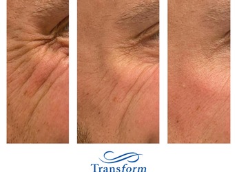 Before and after anti-wrinkle treatment for crows feet. Treatments for men.
