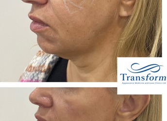 Dermal filler to cheek and jawline for rejuvenation