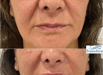 Lower face rejuvenation with dermal fillers