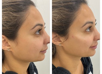 Before and immediately after cheek enhancement