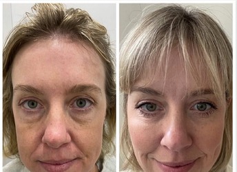 Before and after full face rejuvenation using a combination of botulinum and dermal fillers.