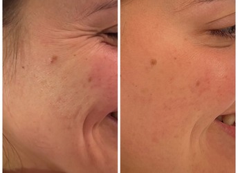 Before and after Dysport treatment