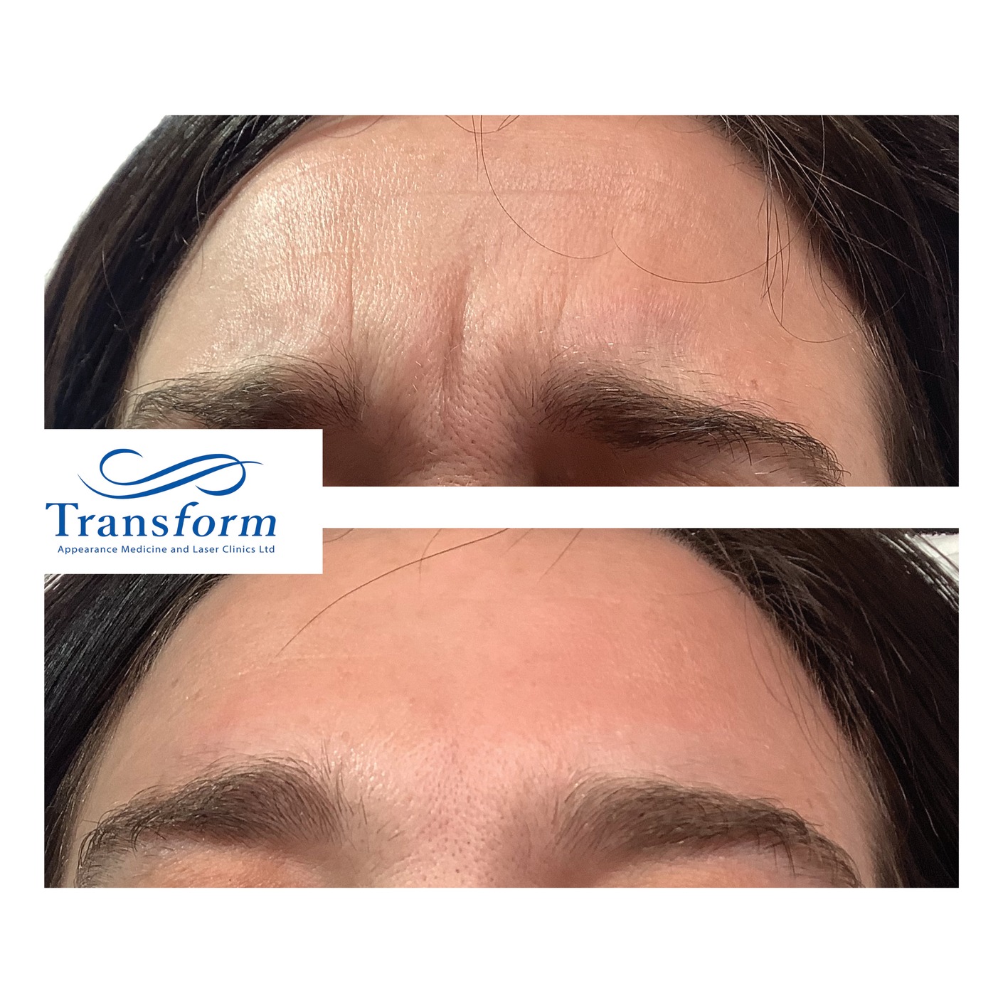 Before and after frown lines botox treatment