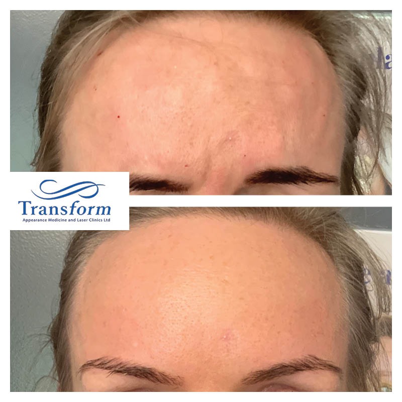 Before and after frown and forehead botox