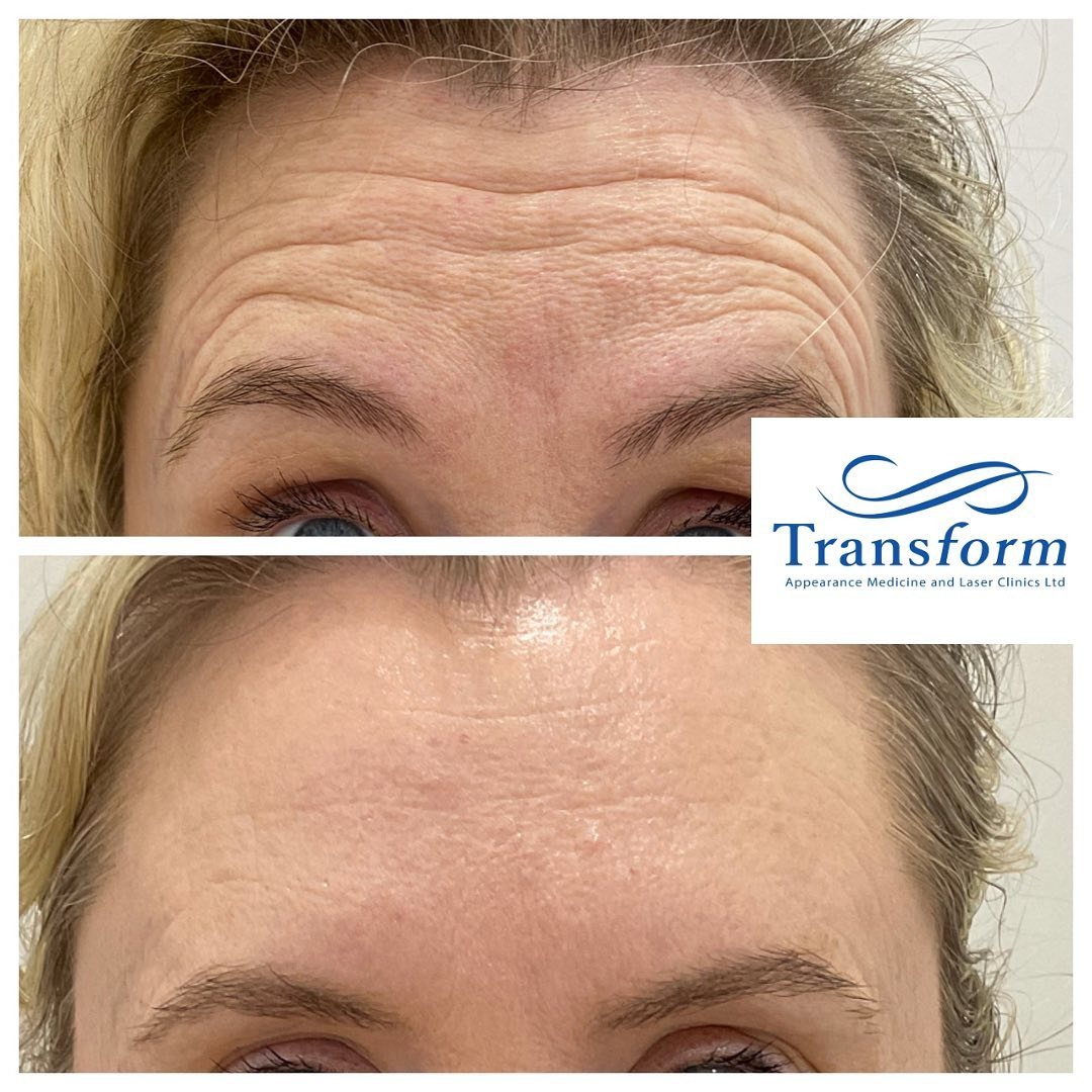 Before and after forehead wrinkle treatment