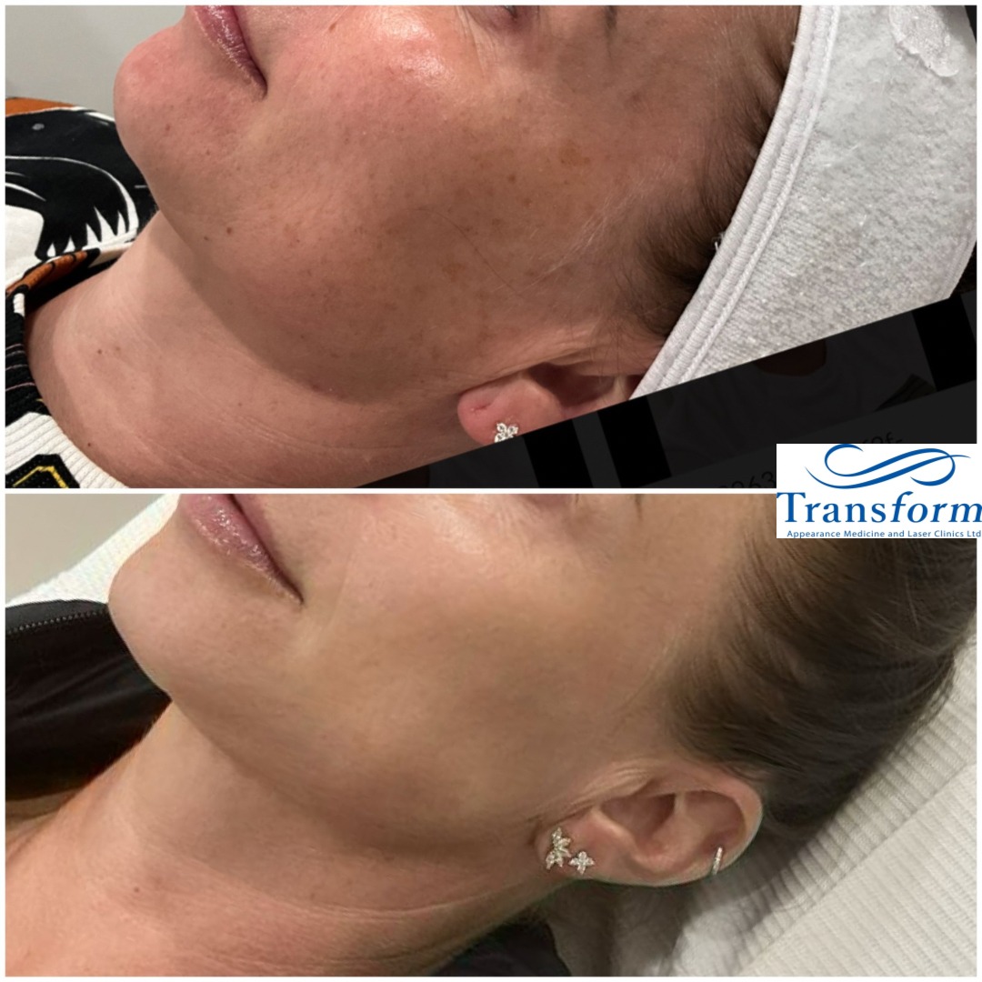 Before and after Fotofacial - Individual results may vary.