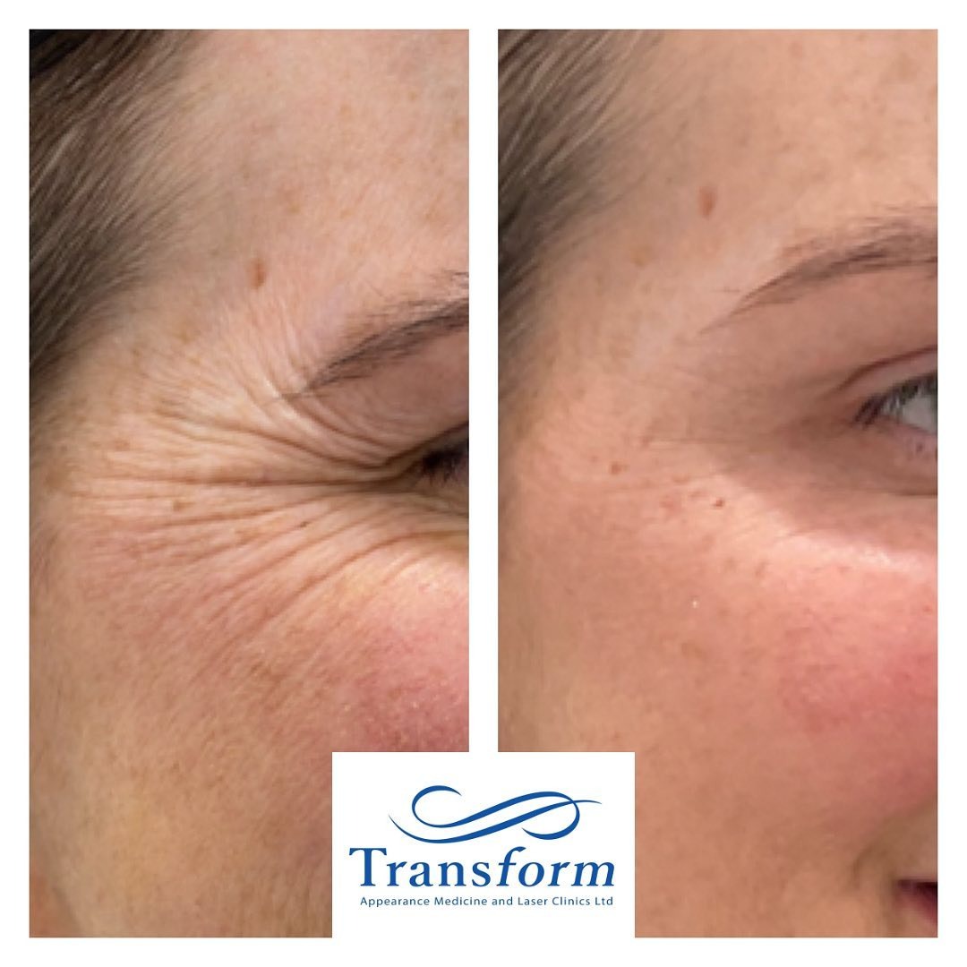 Before and after crows feet botox