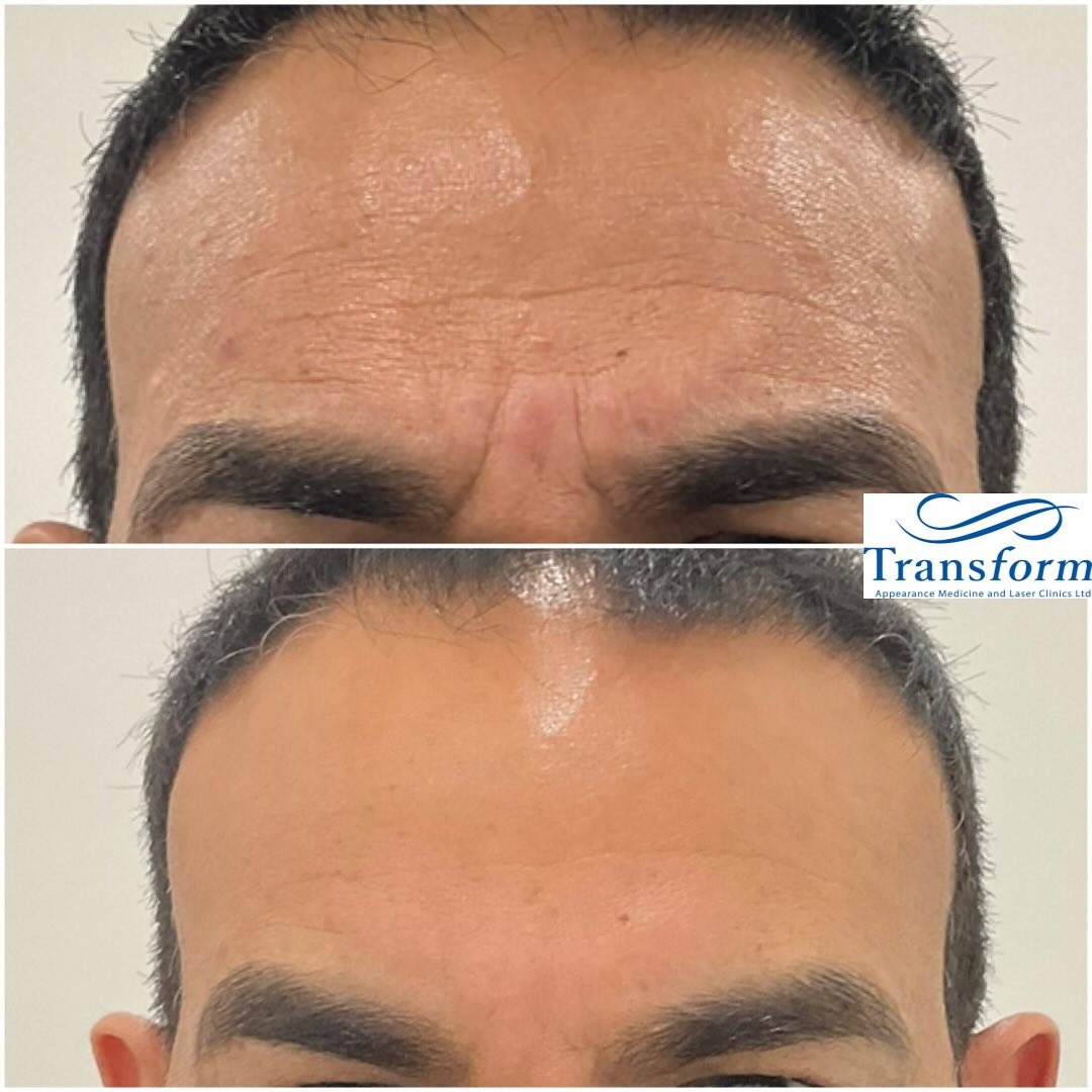 Before and after anti-wrinkle treatment for men and frown line botox