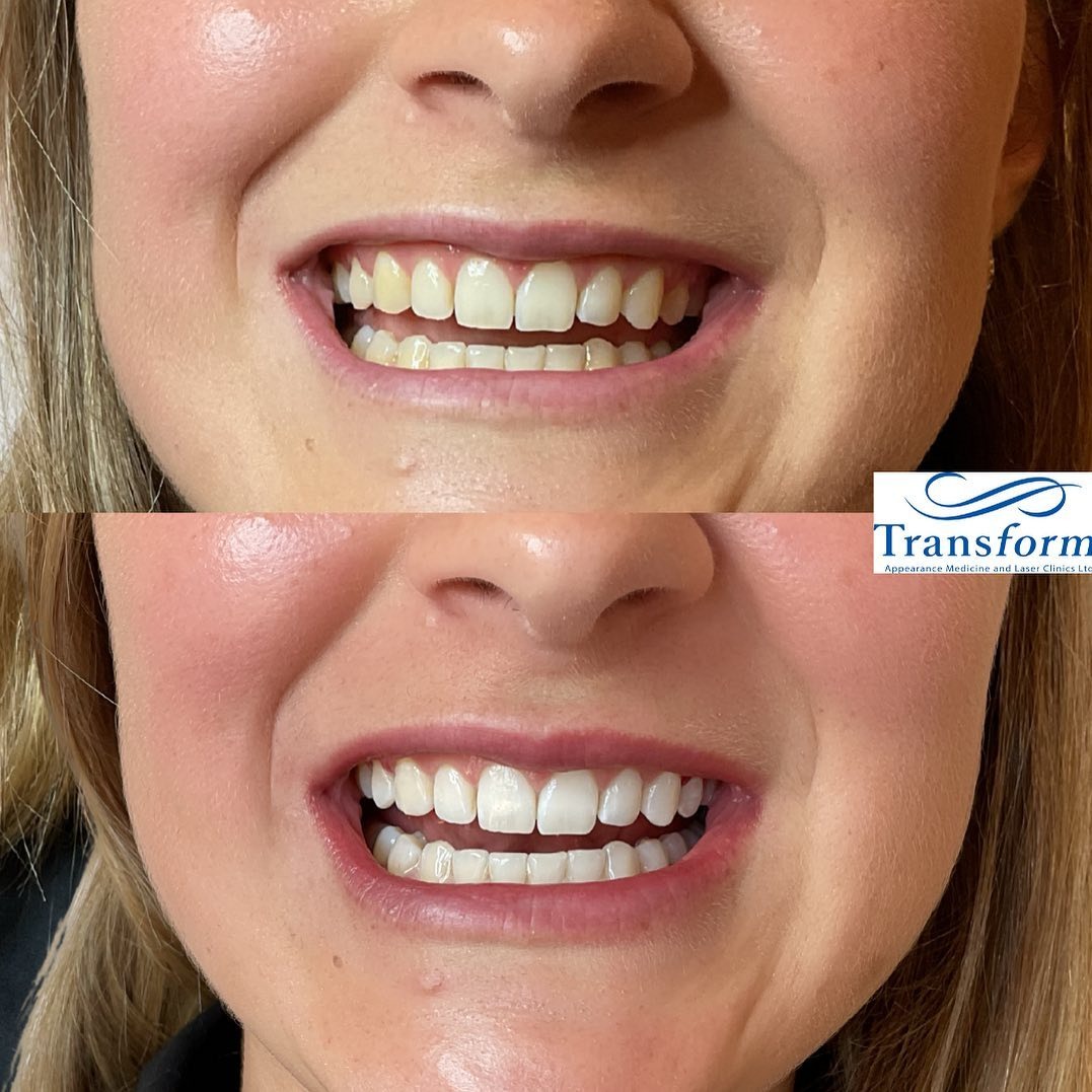 Before and after teeth whitening in christchurch