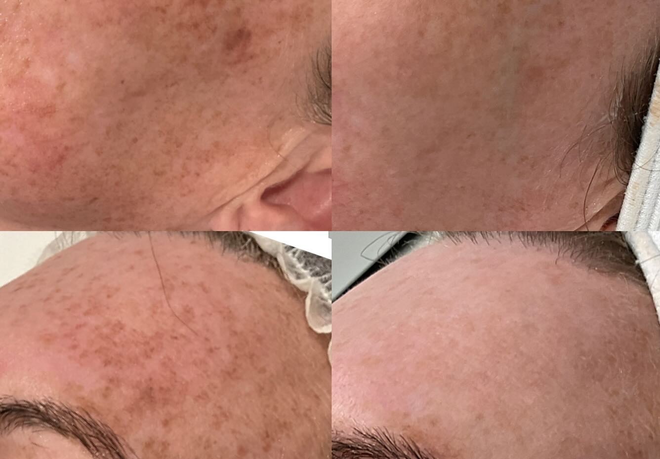 laser skin rejuvenation before and after new zealand