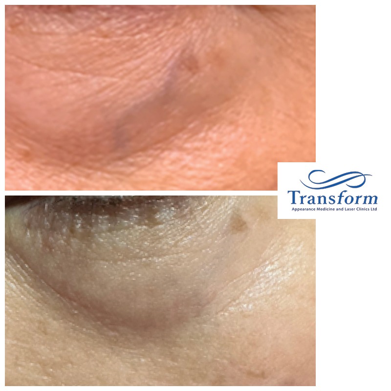 Laser treatment for facial vein