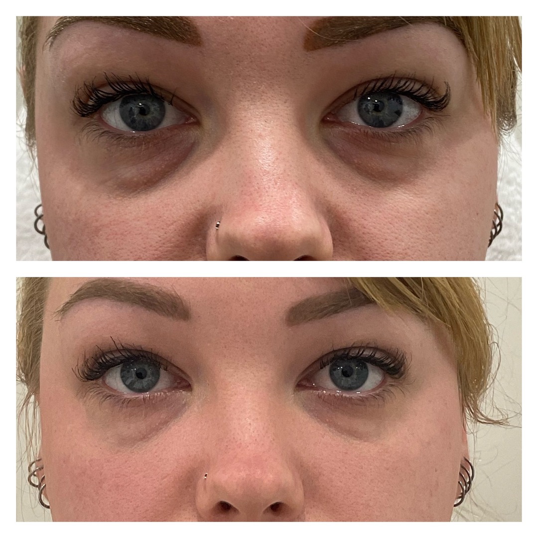 under eye filler before and after photo